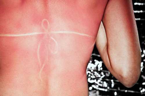 Что делать, если сгорела кожа на солнце: правила и советы