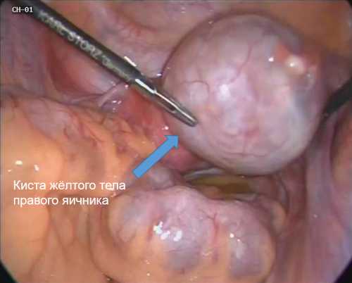 Желтое тело временная железа, образующаяся в яичнике после овуляции, вырабатывающая гормоны, обеспечивающие готовность организма к беременности